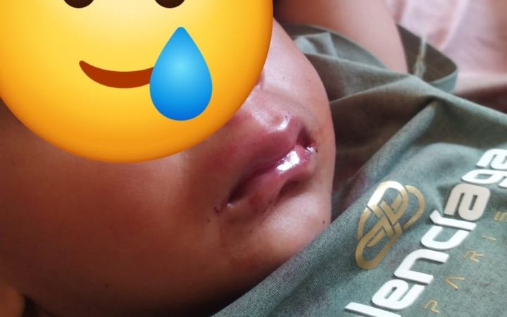 Desil 8 JKA Bikin Balita Korban Kecelakaan di Bireuen Tak Berani ke RS, Pilih Berobat ke Polindes