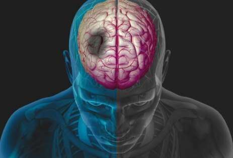 5 Gejala Stroke yang Sering Diabaikan Anak Muda, Jangan Anggap Hanya Vertigo Biasa