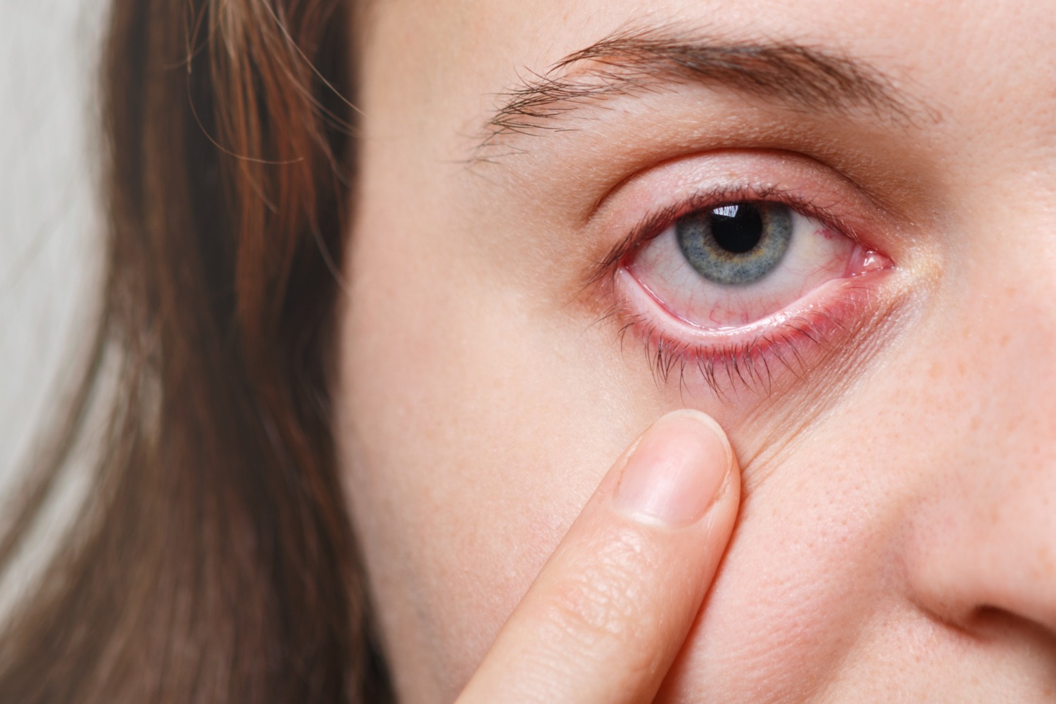 Dokter Mata Bethsaida Hospital Serang: Obat Tetes Sembarangan Bikin Konjungtivitis Berujung Kebutaan