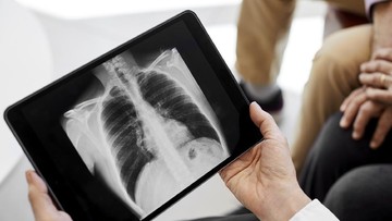 Kabut Asap Karhutla Melemahkan Pertahanan Paru, Risiko Pneumonia Ikut Naik