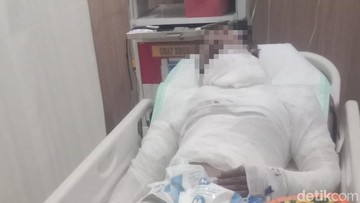 Sopir Truk di Karangasem Dibakar Bosnya gegara Setoran, Korban Luka Bakar Serius