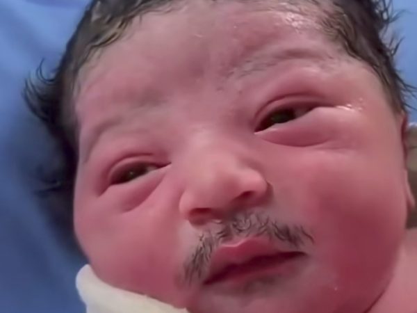 Bayi Baru Lahir Berkumis dan Berjenggot Viral, Ini Penjelasan Lanugo