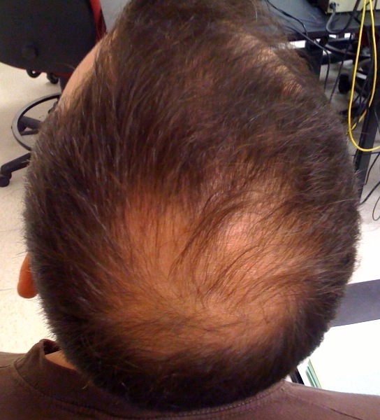 Penyebab Rambut Rontok Parah dan Cara Mengatasinya