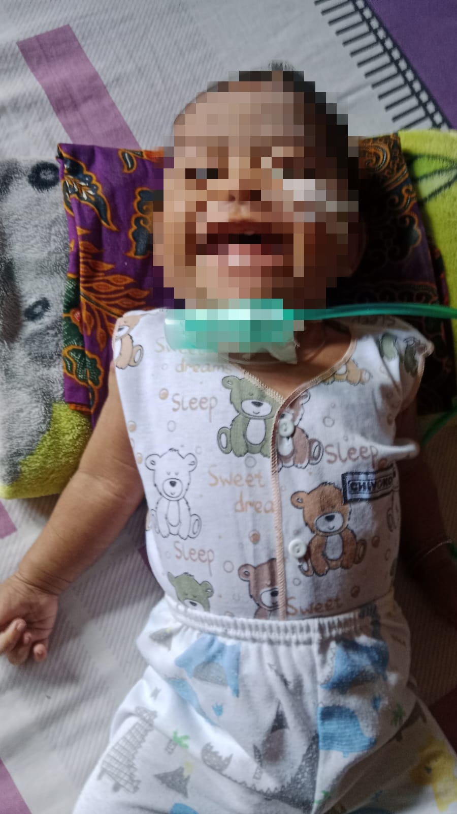 Bayi 8 Bulan di Padang Pariaman Terlahir dengan Langit-Langit Sumbing, Kini Berjuang Melawan TBC dan Meningitis