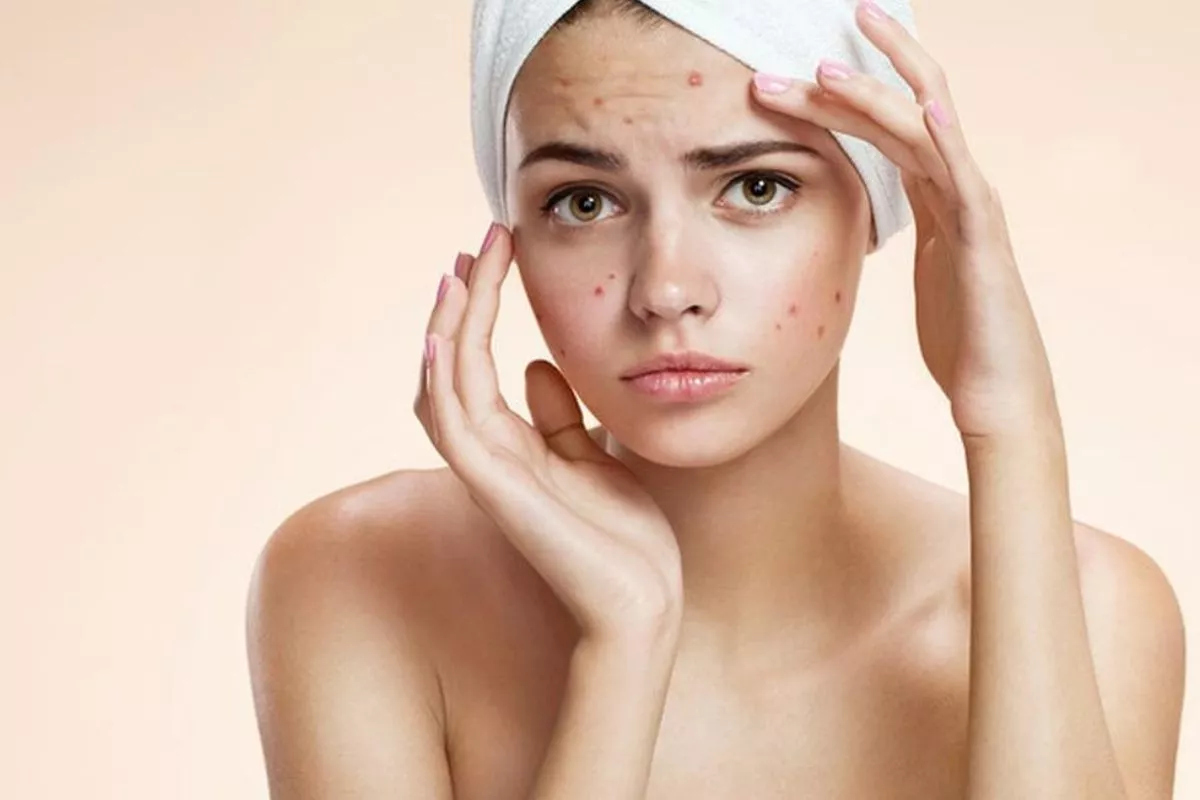 Wajah Mulus Tanpa Skincare Mahal? Ini Cara Mengatasi Jerawat Membandel!