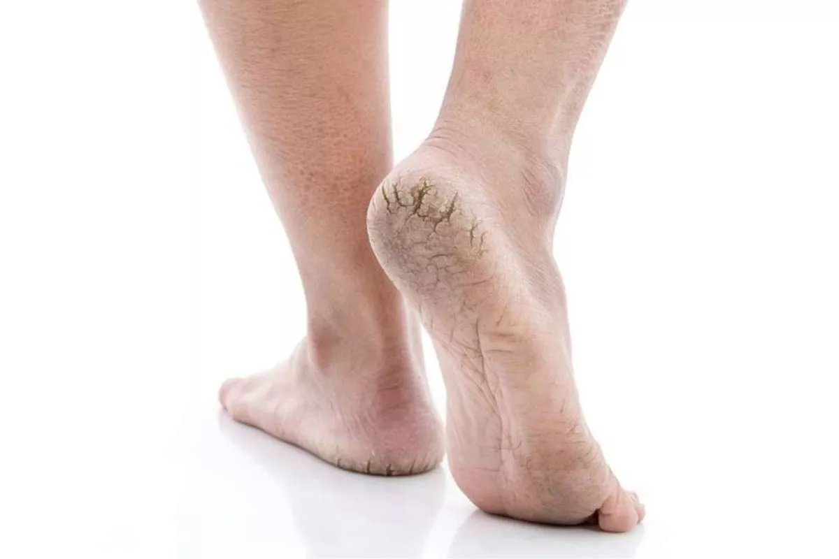 Panduan Lengkap 4 Cara Mengatasi Kulit Tumit Kaki Pecah-Pecah