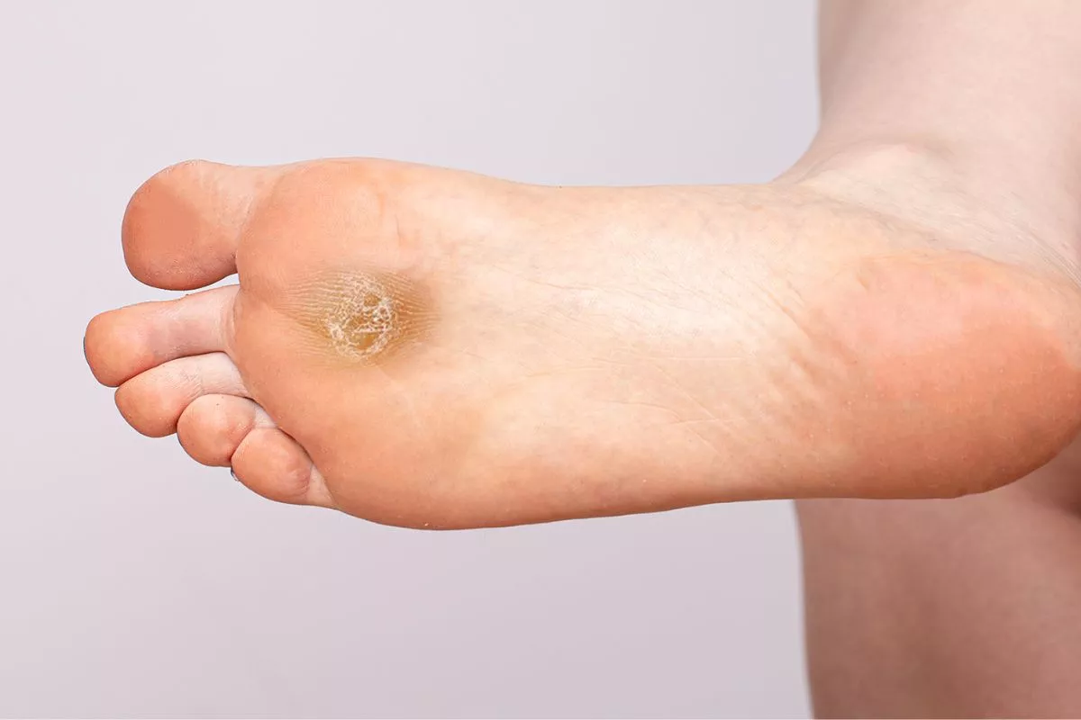 Kaki Kasar dan Kebas? Ini Cara Menghilangkan Kapalan di Kaki yang Benar