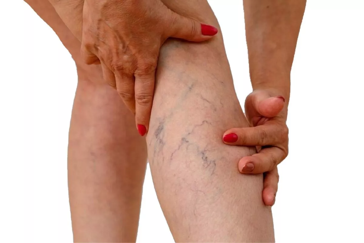 Kaki Jadi Korban! Kenapa Duduk Terlalu Lama Bikin Varises Menonjol?